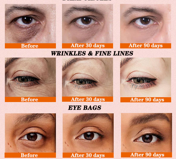 High-energy red and blue light eye beauty device to remove fine lines, eye bags and dark circles around the eyes